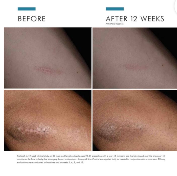 SkinCeuticals Advanced Scar Control - Picture 4 of 9
